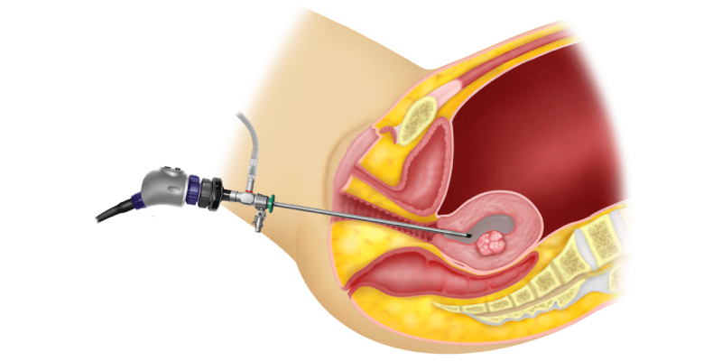 Hysteroscopy Guide