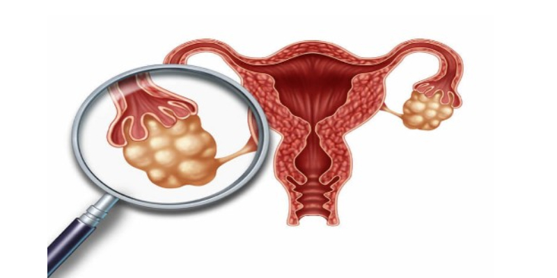 PCOS Polycystic Ovarian Syndrome