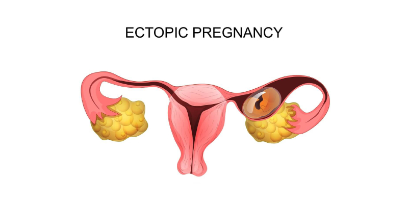 Ectopic Pregnancy