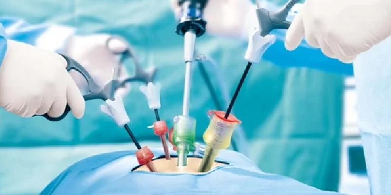 Laparoscopy for Ovarian Cysts