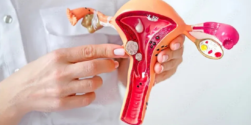 Uterine Polyp and Fertility