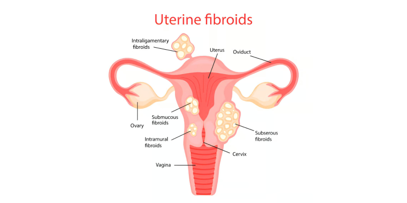 Fibroid Surgery Without Big Cut