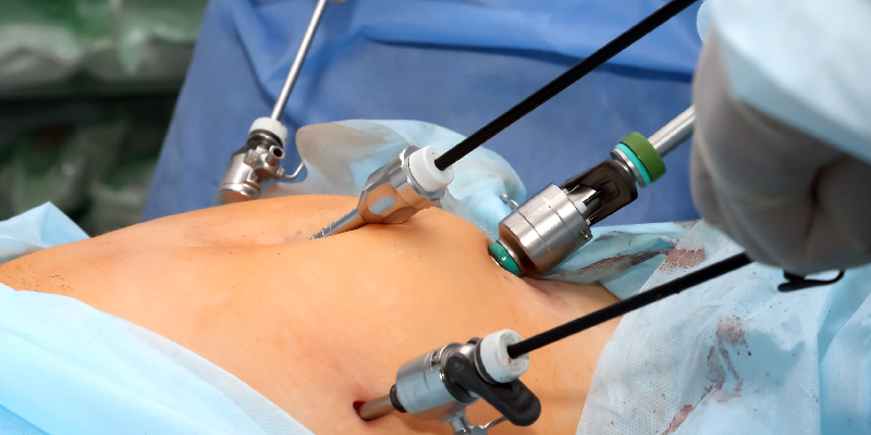 Total Laparoscopic Hysterectomy