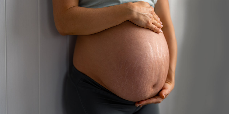 Stretch Marks in Pregnancy