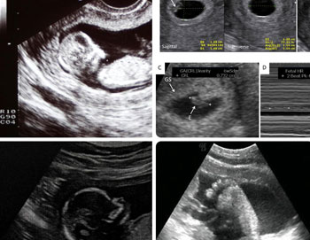 Fibroid surgery without big cut