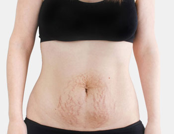 Fibroid surgery without big cut