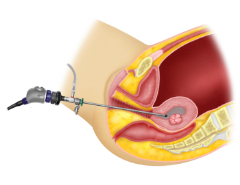 ⁠Hysteroscopy