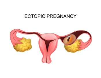 ⁠Ectopic Pregnancy 