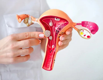 ⁠⁠⁠Polyp in the Uterus: Does It Affect Fertility?