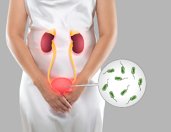 ⁠⁠⁠Urinary tract infections in women