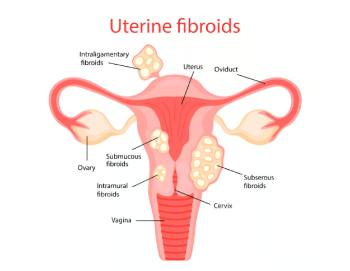 ⁠⁠⁠⁠Fibroid surgery without big cut- modern options