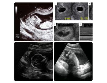 ⁠⁠⁠⁠How to Read a Pregnancy Ultrasound Report