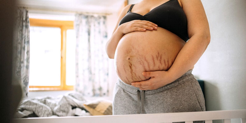 Stretch Marks in Pregnancy