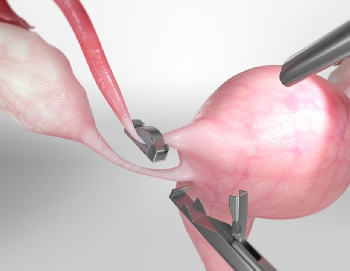 Breaking the Silence PTSD